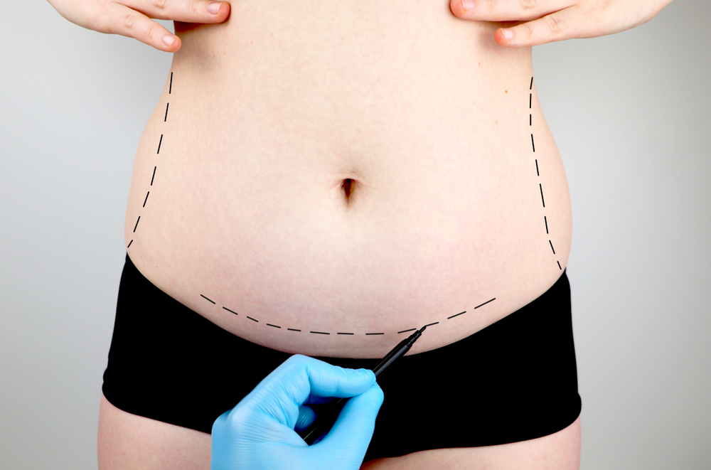 Para eliminar flacidez abdominal, são feitas marcações para realizar abdominoplastia